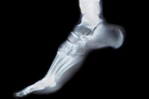 Radiographie du pied et de la cheville