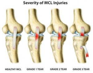 Common Questions About MCL Knee Sprains