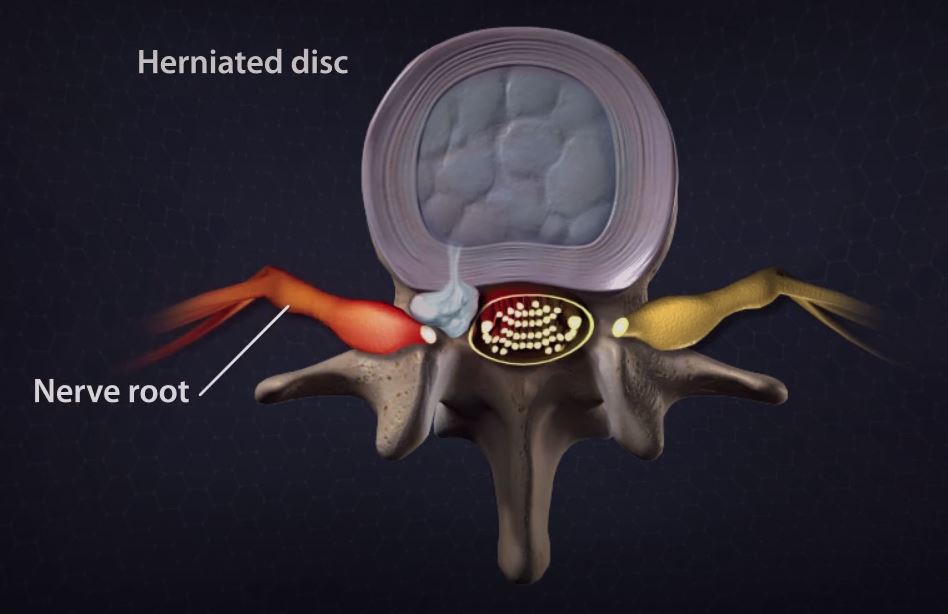 A Herniated Disc Could Be The Reason if Your Back is Hurting