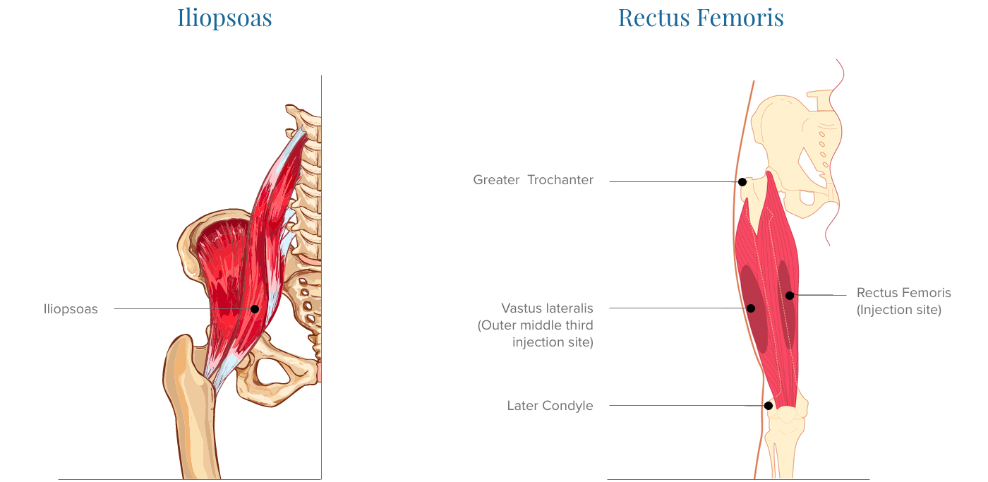 rectus femoris injection site