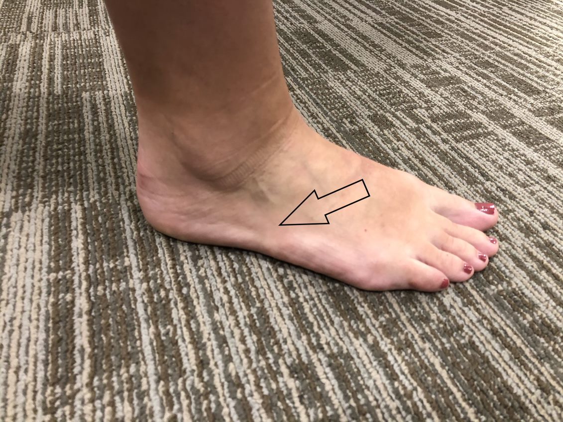 Does Your Foot Hurt Here?: The Outside of the Foot