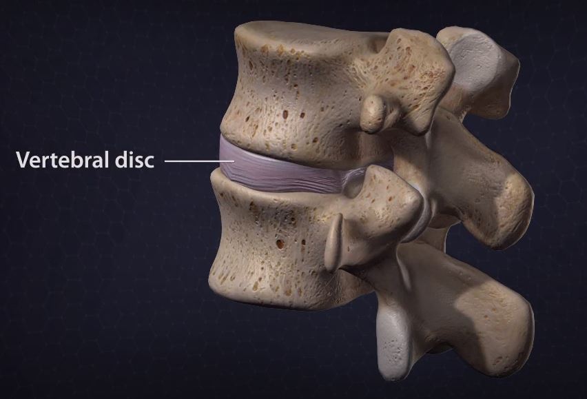 Pillow of Degenerative disc disease, 3D CT scan